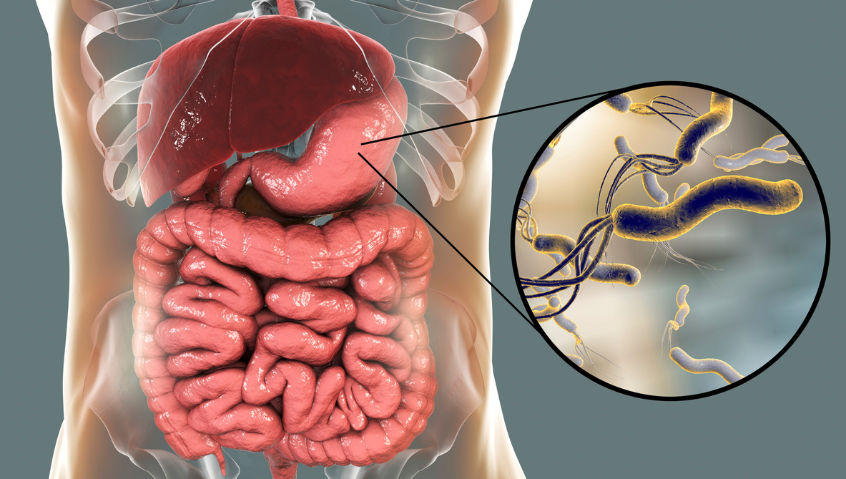 H pylori Infection Linked With Increased Alzheimer's Risk